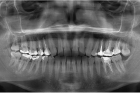Панорамный снимок зуба