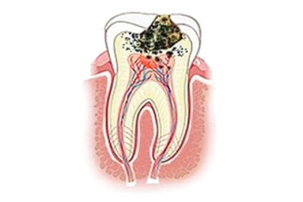 Лечение глубокого кариеса, вторичного депульпированного зуба