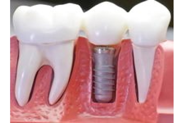 Восстановление коронки зуба с помощью униметрика