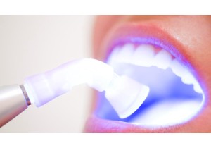 Снятие зубных отложений при помощи ультразвука