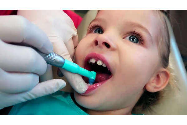 Покрытие зуба реминерализующим гелем