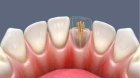 Восстановление коронки зуба с помощью стекловолоконного штифта
