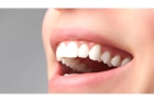 Протезирование зубов протезами