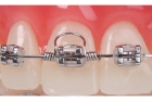 Установка на один зуб металлической, эластической лигатуры, звена цепочки, пружины или вращающего клина