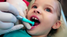 Покрытие зуба реминерализующим гелем