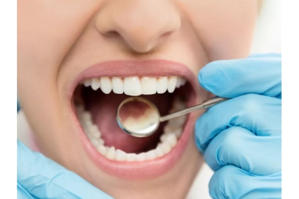 Восстановление зубов фотопломбой (при утрате 30%)