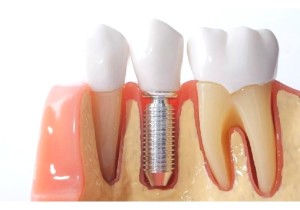 Имплант зуба с коронкой металлокерамика