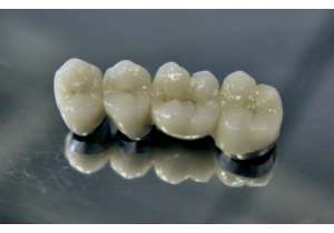 Металлокерамика коронка на зуб