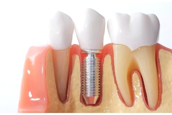 Имплант зуба с коронкой металлокерамика