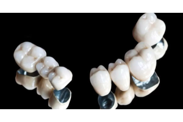 Коронка зуба металлокерамическая