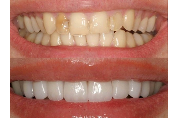 Эстетическая реставрация зубов  