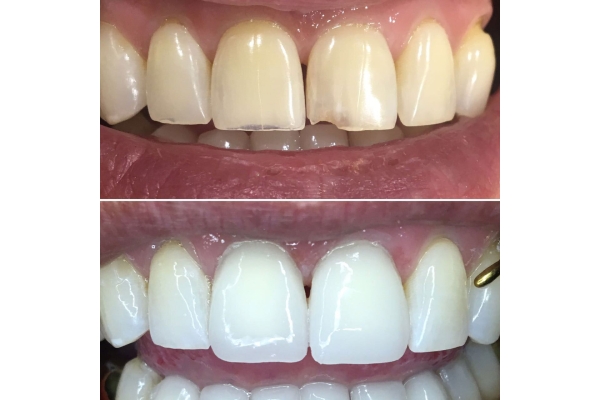 Реставрация поверхности зуба 