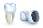 Полное удаление пломбы или трепанация коронки зуба