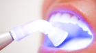 Снятие зубных отложений при помощи ультразвука