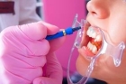 Покрытие шейки зуба фтор-протектором