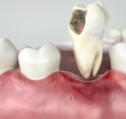 Лечение кариеса депульпированного зуба 