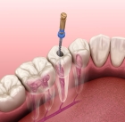 Лечение пульпита 1 канального зуба