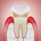 Лечение периодонтита 2 канального зуба