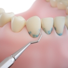 Снятие над и поддесневых отложений с зубов
