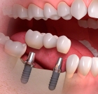 Восстановление зуба (Титановый пост)