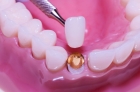 Восстановление зуба под коронку 