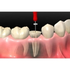 Пломбировка 1 канального зуба