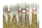 Имплант на удаленный зуб