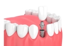 Зубной имплант 1 зуба