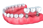 Дешевые импланты зубов