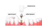 Импланты зубов нижней челюсти