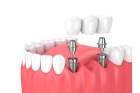 Имплантационная система в стоматологии