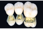 Коронка на зуб металлокерамика