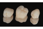 Коронки металлокерамика на передние зубы