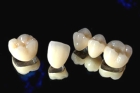 Коронка металлокерамика на зуб в стоматологии