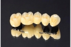 Коронка металлокерамика на зуб дешево