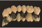 Коронка металлокерамика на зуб под ключ