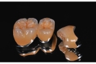 Коронка металлокерамика на жевательный зуб