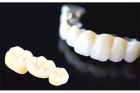 Коронки металлокерамика  на верхние зубы