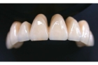 Коронки металлокерамика на нижние зубы