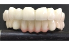 Коронки металлокерамика на передние верхние зубы