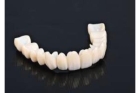 Коронки металлокерамика на передние нижние зубы