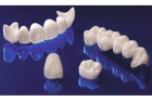 Зубная коронка металлокерамика