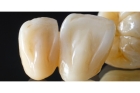 Недорогие коронки из циркония на зубы