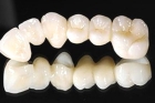 Коронки из циркония на нижние зубы
