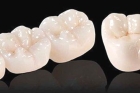 Циркониевая коронка на задние зубы