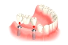 Коронка зуба на имплант