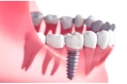 Зубная коронка на имплант