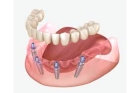 Коронки на импланты зубов