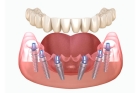 Коронка на имплант в стоматологии