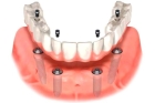 Коронка на имплант заднего зуба